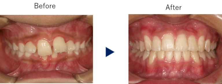 出っ歯のお悩み相談から埋伏歯が判明 岐阜県大垣市のよろず矯正歯科